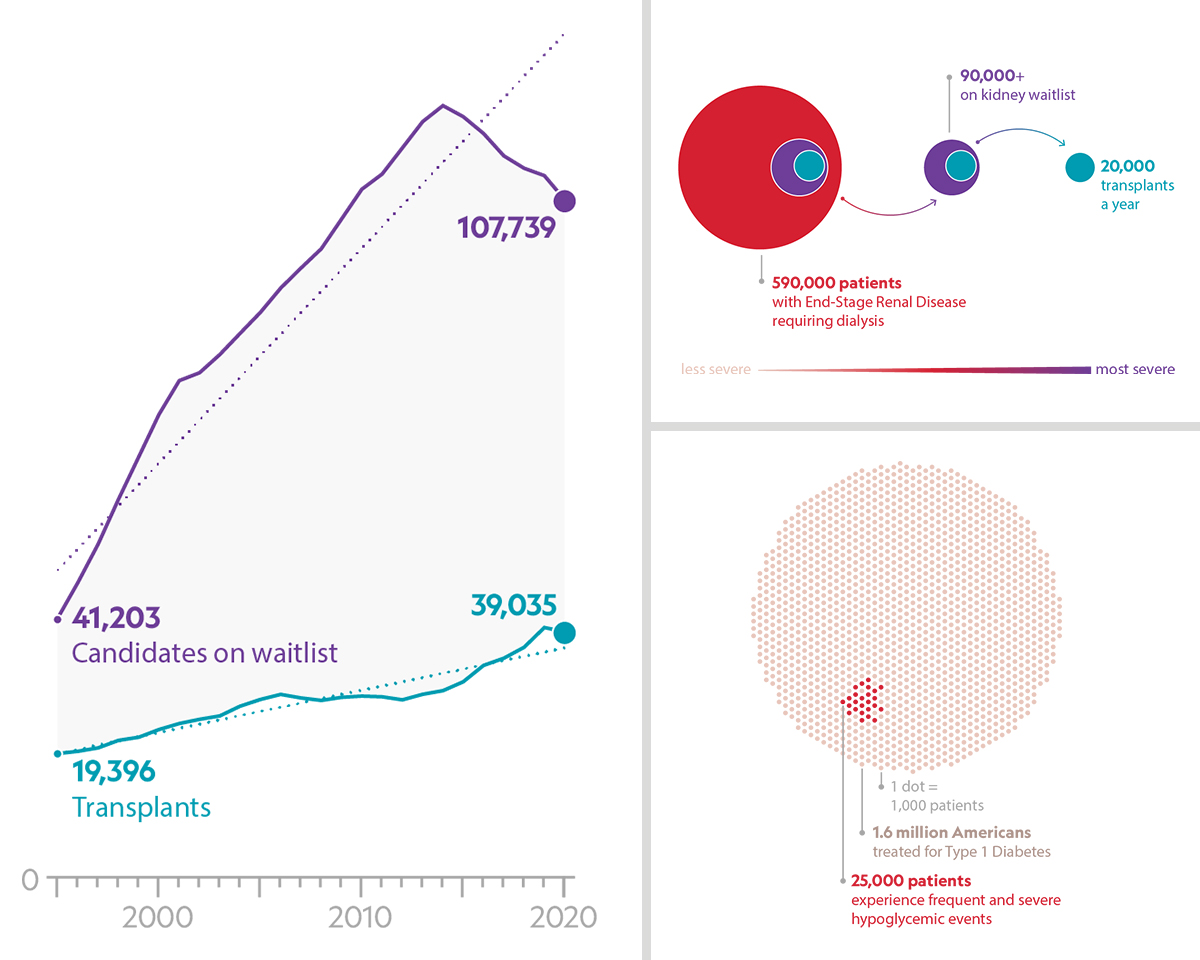 Unmet-need data visualization: the widening gap between kidney transplant candidates on the waitlist and transplants performed from the 1990s to 2020, the 590,000 patients with end-stage renal disease requiring dialysis narrowing to 20,000 transplants a year, and a dot grid showing severe hypoglycemic events among 1.6 million Americans with Type 1 diabetes.